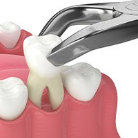 Digital image of a tooth extraction