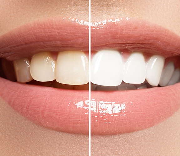 smile before and after teeth whitening