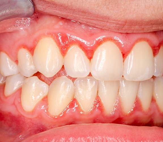 View of red and swollen gum tissue