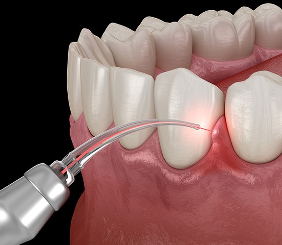 Digital image of dental laser treating infected tissue