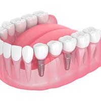 Dental implant bridge in Aurora