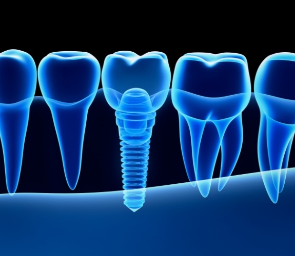 Computer illustration of dental implant