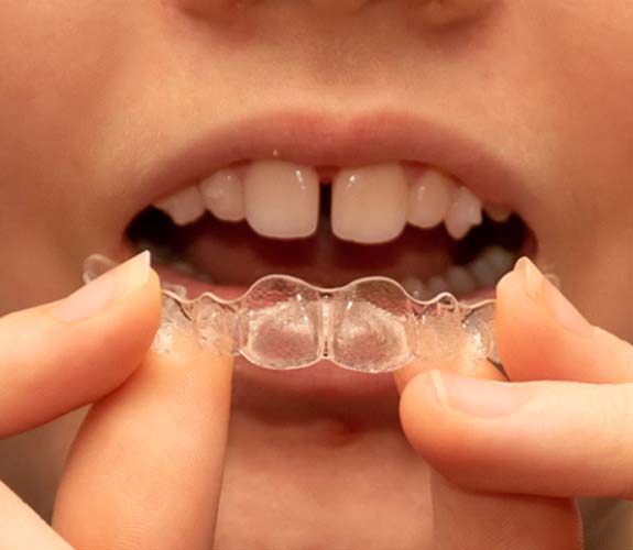 Invisalign Teen in Aurora