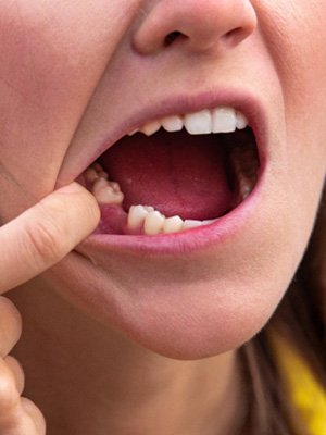 Woman with a missing tooth