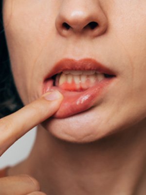 Woman with gum irritation