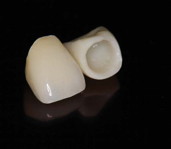 Metal-free zirconia crowns on black background