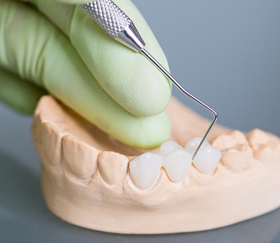 mock up dental bridge