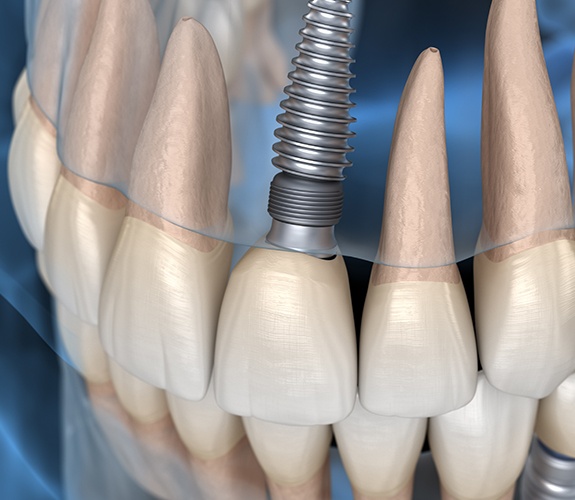 implant in smile