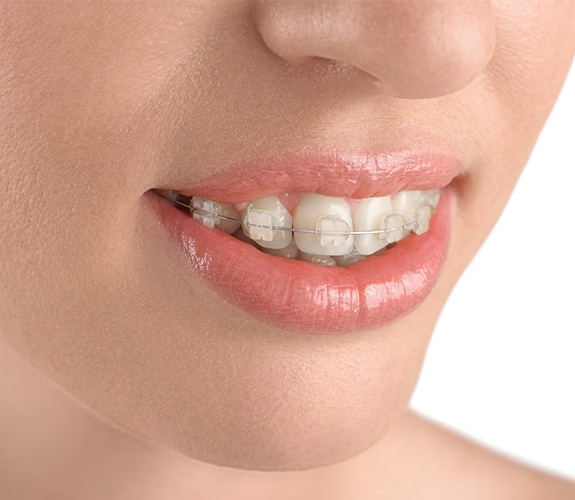 woman with tooth colored braces