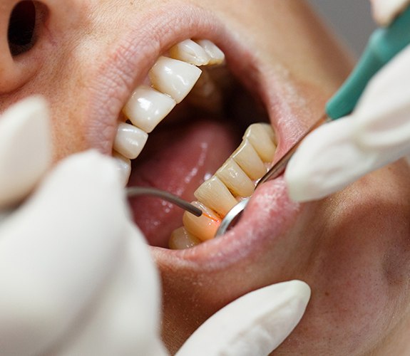 dentist using soft tissue laser in mans mouth
