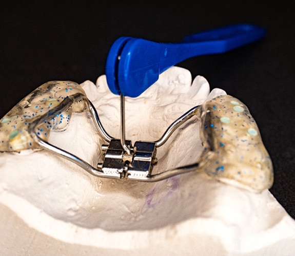 Palatal expander used for Phase 1 orthodontics in Aurora, IL