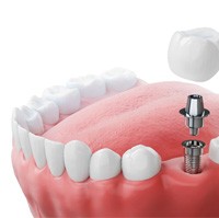 Dental implant in Aurora 