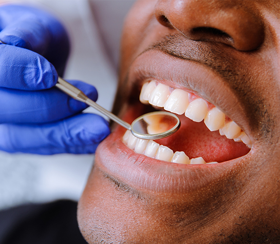 man with tooth colored fillings