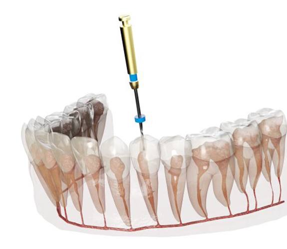 Digital image of a root canal