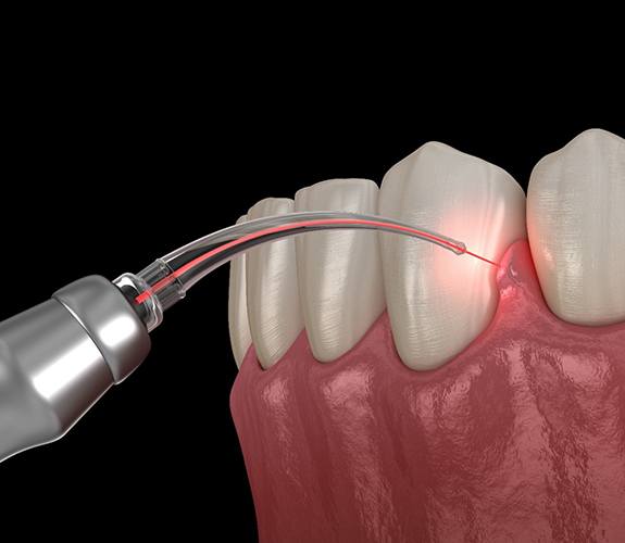 Soft tissue laser in Aurora