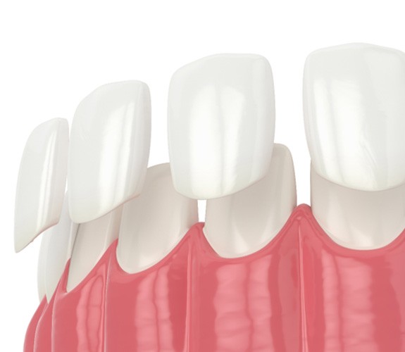 Dental veneers in Aurora 