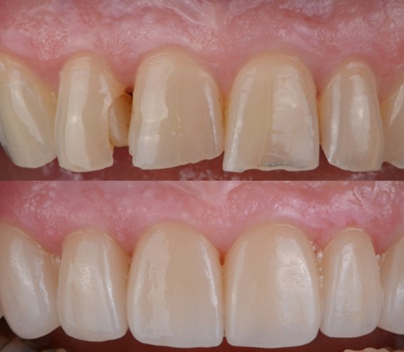 Before and after veneers in Aurora 