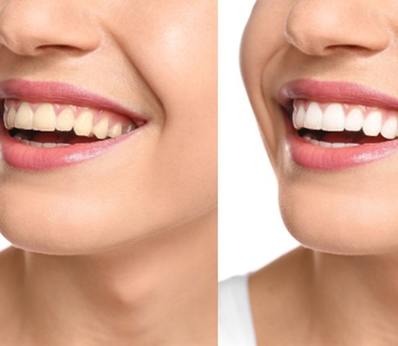 Before and after image of teeth whitening
