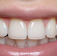 Before and after teeth whitening