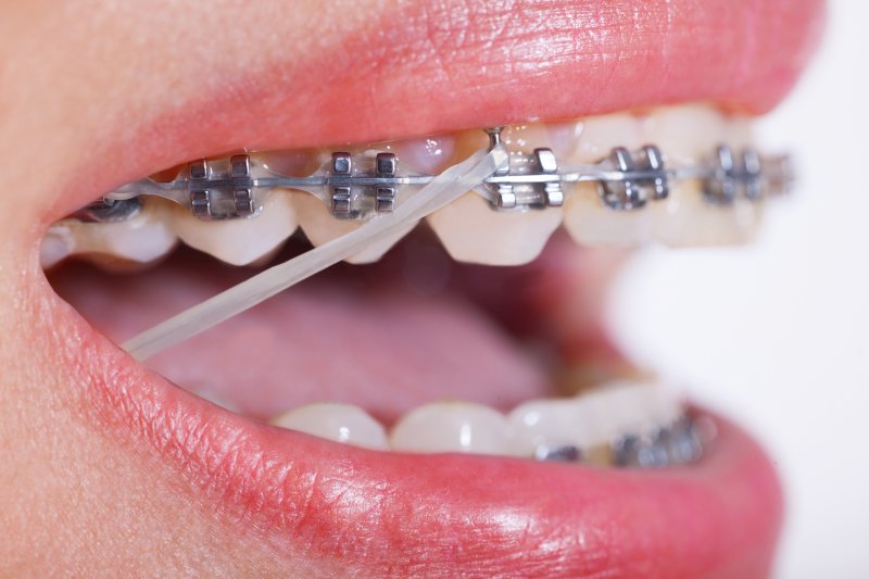 Close-up of braces with rubber bands