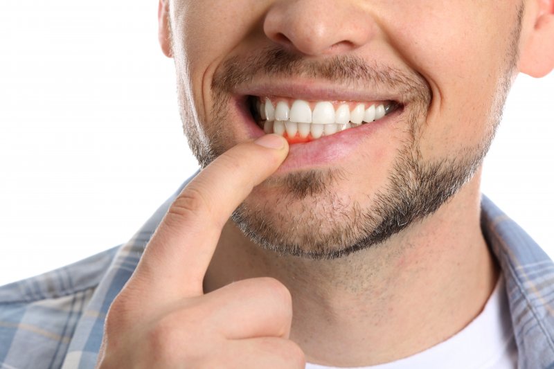 Man pulling down lower lip to show gum disease