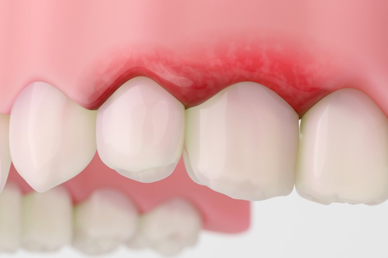 digital image of gum disease