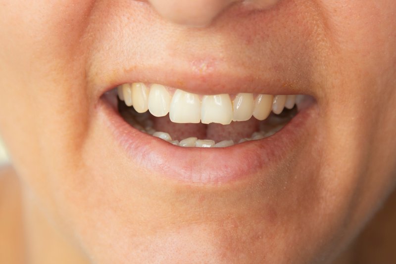 man with a chipped front tooth